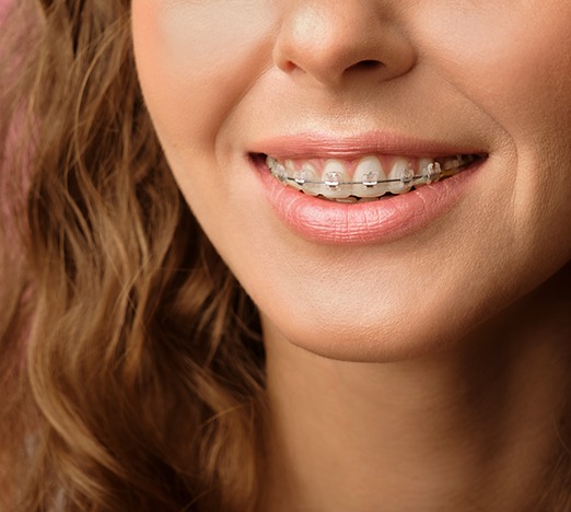 Close-up of woman’s smile with dental braces