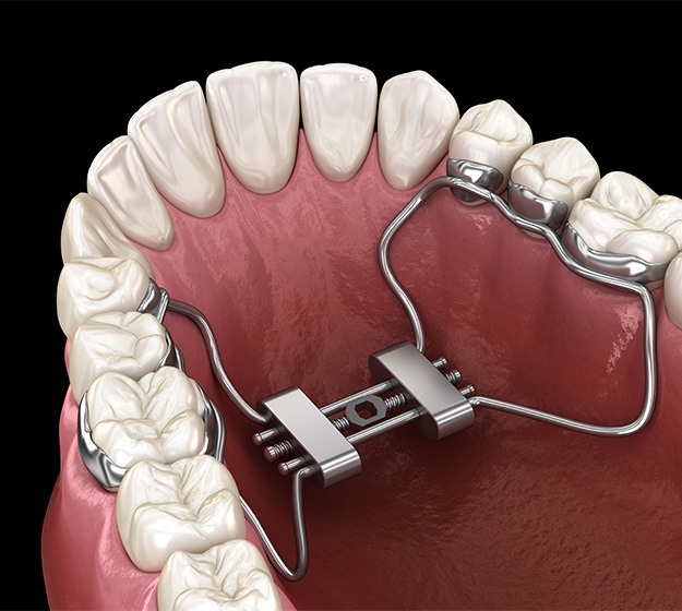 A palate expander in Plano 