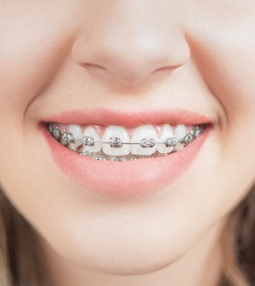 Traditional Braces Plano, TX | Children’s Orthodontics | Female ...