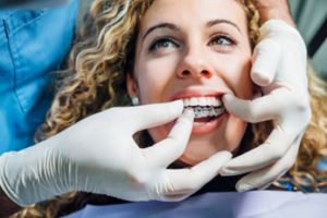 Orthodontist preparing to remove a patient’s Invisalign attachments by taking out her trays